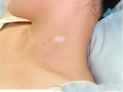 颈处的白斑会对患者有危害吗
