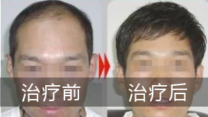 男性患者如何预防白斑的危害呢