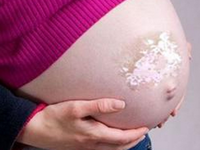 白癜风患者在怀孕期间的注意事项