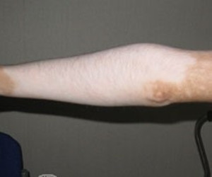 肢端型白癜风发病因有哪些